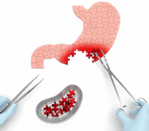 Partial Gastrectomy